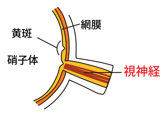 白内障とは